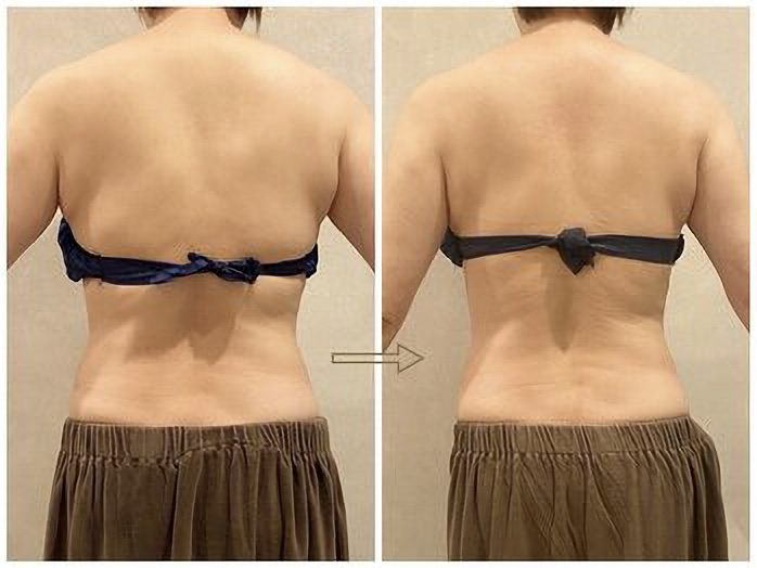 背中before→after